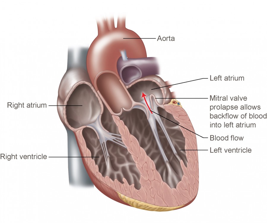 Illustration of Mitral Valve Prolapse Comprehensive Guide Symptoms Diagnosis Management MCQs symptoms