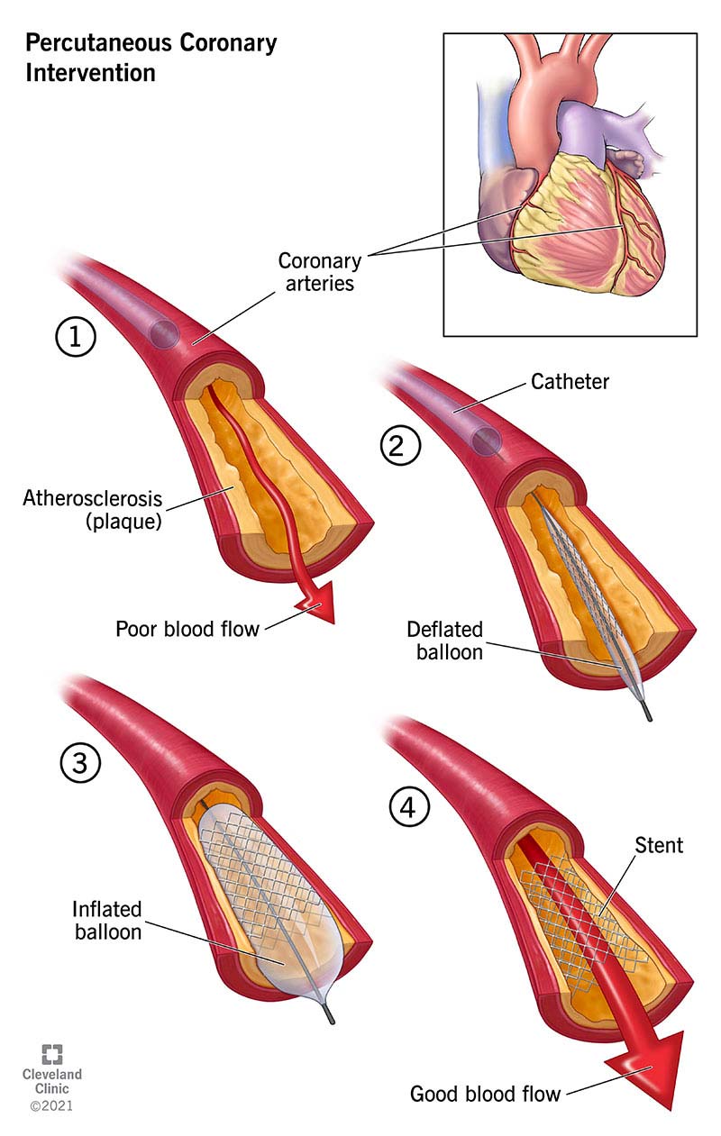 Illustration of Percutaneous Coronary Intervention PCI Procedure Indications Steps Complications Management symptoms