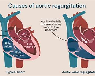 Illustration of Aortic Regurgitation Comprehensive Guide Causes Symptoms Diagnosis Treatment symptoms