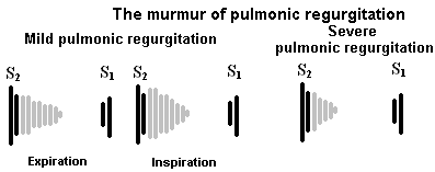 Illustration of Tricuspid and Pulmonary Valve Murmurs Explained TS TR PS PR Clinical Guide symptoms