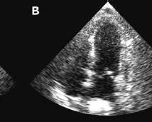 Illustration of Takotsubo Cardiomyopathy Brugada Syndrome and Sudden Cardiac Death Complete Clinical Guide symptoms