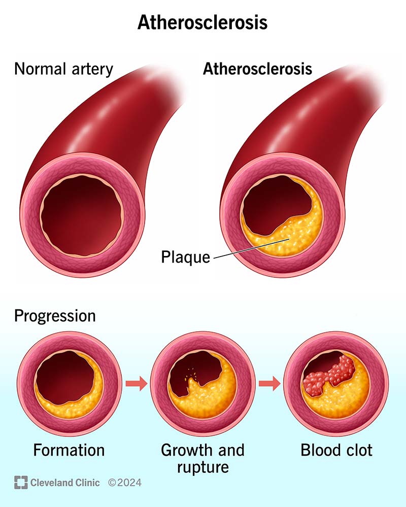 Illustration of Ischemic Heart Disease Comprehensive Clinical Guide Diagnosis Management and Prevention symptoms