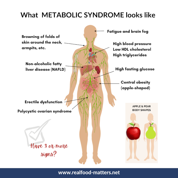 Illustration of Metabolic Syndrome X Causes Diagnosis Management and Prevention Guide symptoms