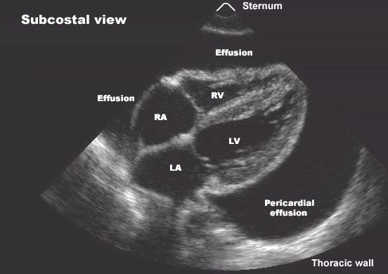 Illustration of Diseases of the Pericardium Clinical Guide Acute Pericarditis Cardiac Tamponade symptoms