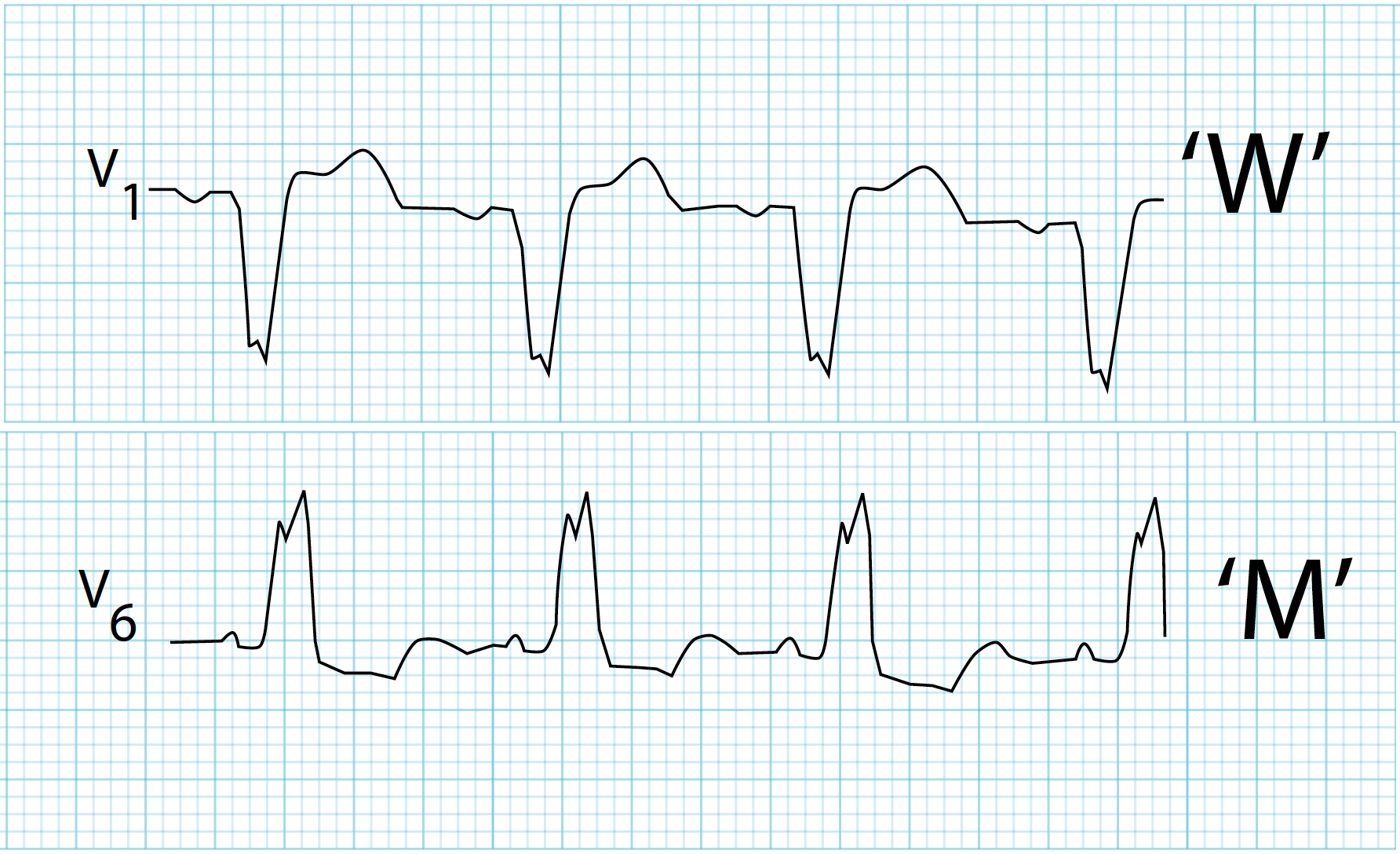 Illustration of Bundle Branch Block Clinical Features Diagnosis and Management Guide symptoms