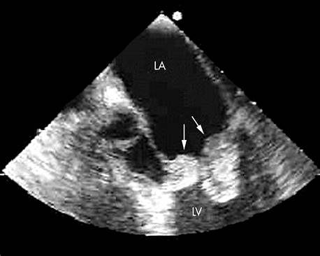Illustration of Infective Endocarditis Clinical Features Diagnosis and Management Guide symptoms