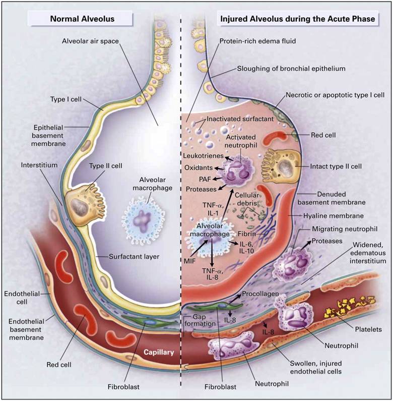 Illustration of Acute Respiratory Distress Syndrome Clinical Features Diagnosis and Management Guide symptoms