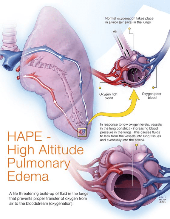 Illustration of High Altitude Pulmonary Edema and Hypothermia Clinical Features Diagnosis and Management symptoms