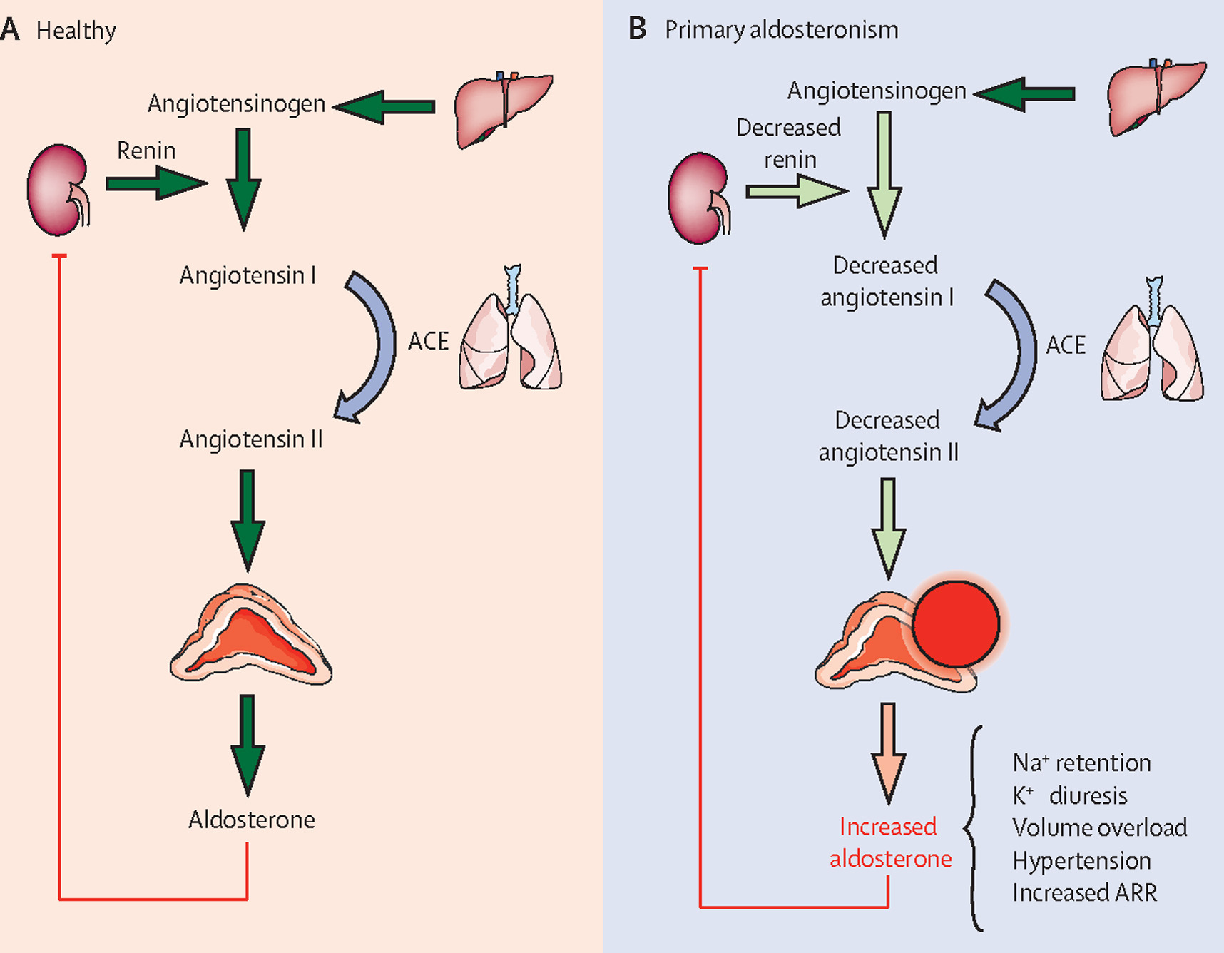 Illustration of Hyperaldosteronism Clinical Features Diagnosis and Management Guide symptoms