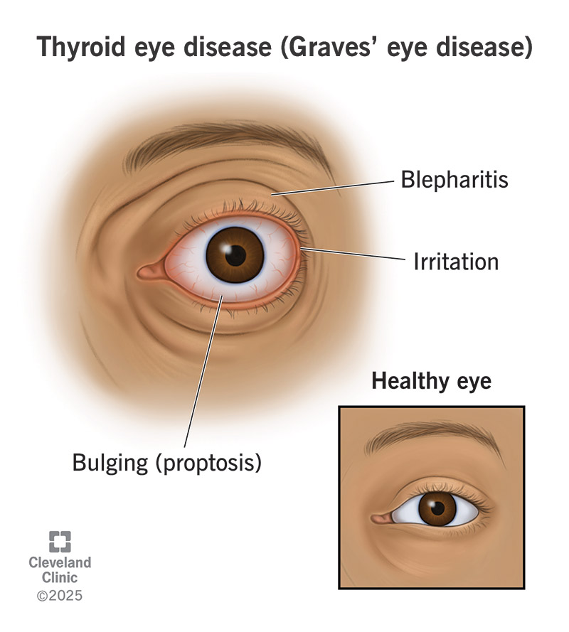 Illustration of Hyperthyroidism Clinical Guide Diagnosis Causes Symptoms Treatment symptoms