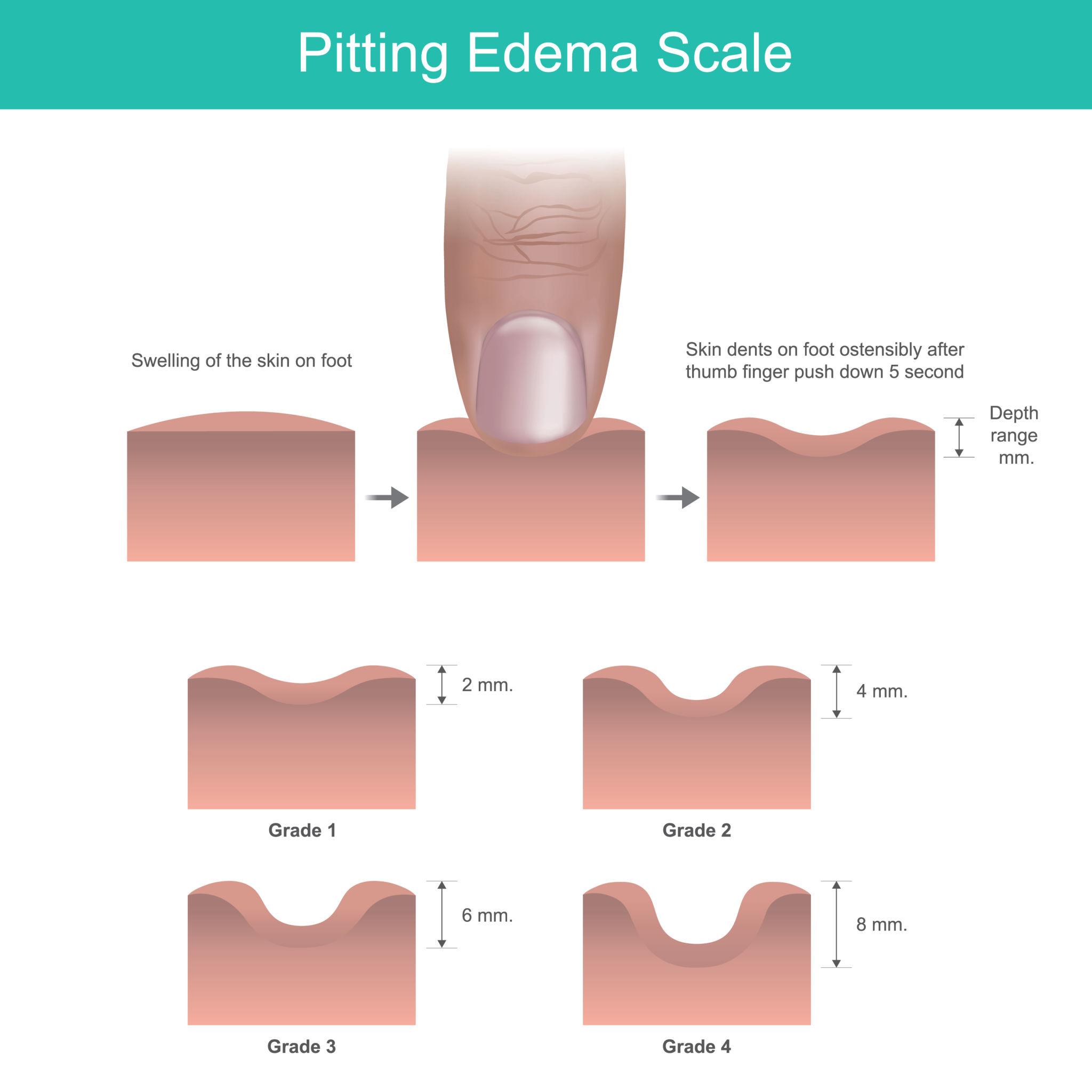 Illustration of Edema Causes Symptoms Diagnosis and Complete Medical Management symptoms